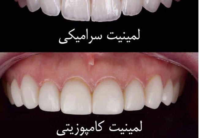 ونیرکامپوزیت دندان