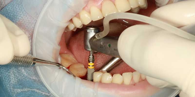 ایمپلنت دندان با بیهوشی | سِـدِیشن- ایمپلنت تحت آرامبخشی