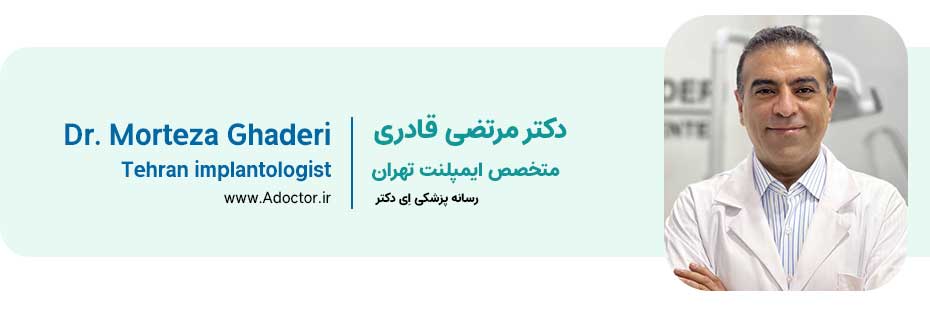 دکتر قادری دکتر ایمپلنت در تهران